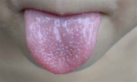 舌根 紅色 顆粒
